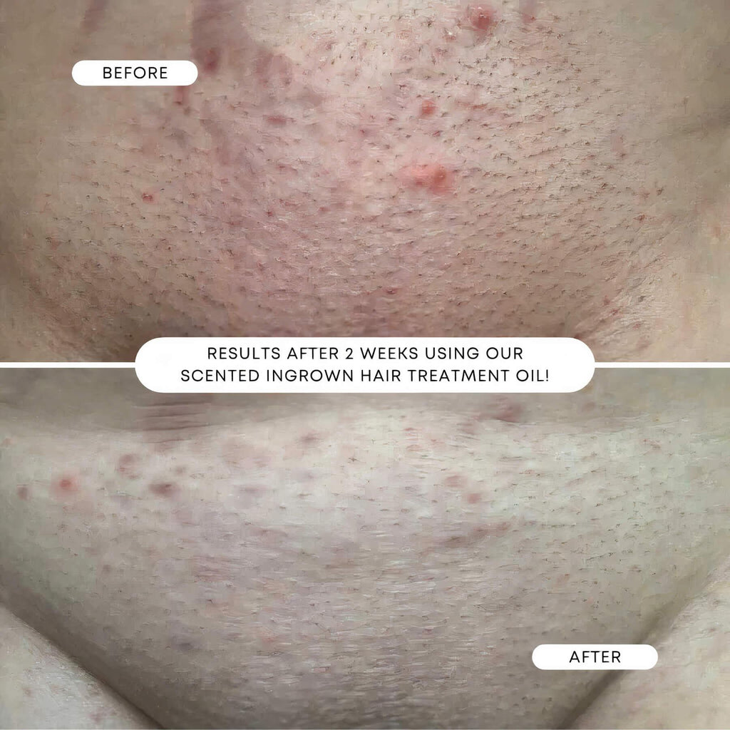 BushBalm | Sweet Escape Ingrown Hair Oil